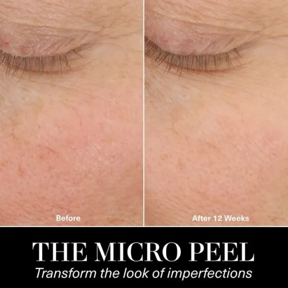 The Micro Peel Facial Peeling